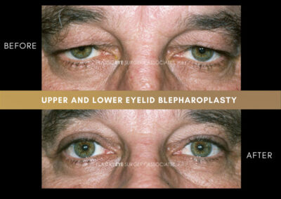 Male Blepharoplasty Photos 11