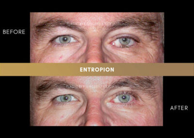 Ectropion/Entropion Photos 19