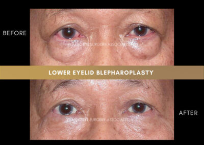 Lower Blepharoplasty Photos 41