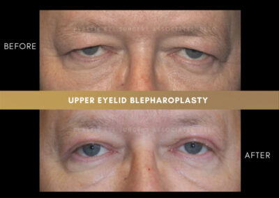 Male Blepharoplasty Photos 9