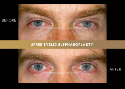 Upper Eyelid Aesthetics Photos 23