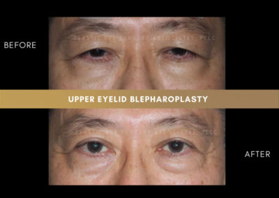 Male Blepharoplasty Photos 30