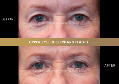 Upper Eyelid Aesthetics Photos 24