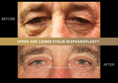Male Blepharoplasty Photos 31
