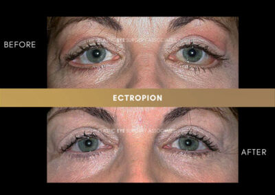 Ectropion/Entropion Photos 3