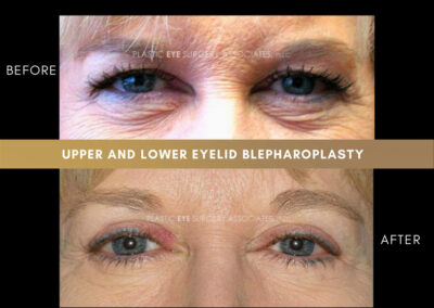 Lower Blepharoplasty Photos 44