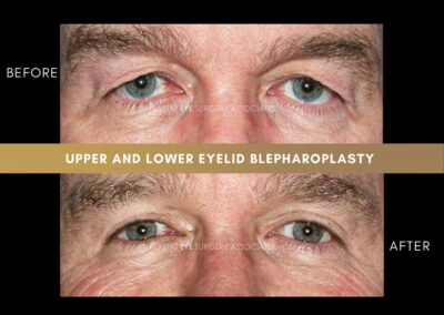 Lower Blepharoplasty Photos 45
