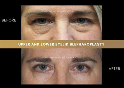 Lower Blepharoplasty Photos 46