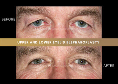 Male Blepharoplasty Photos 8