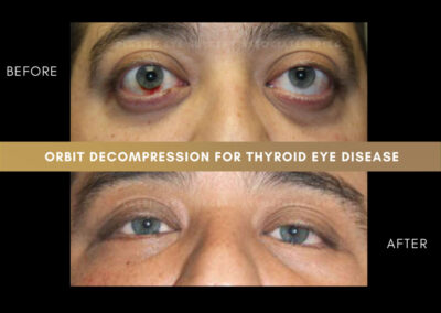 Thyroid Eye Disease Photos 29