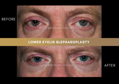 Lower Blepharoplasty Photos 1