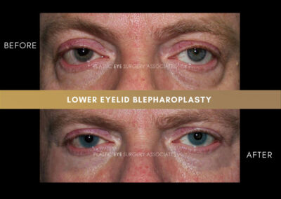 Male Blepharoplasty Photos 7