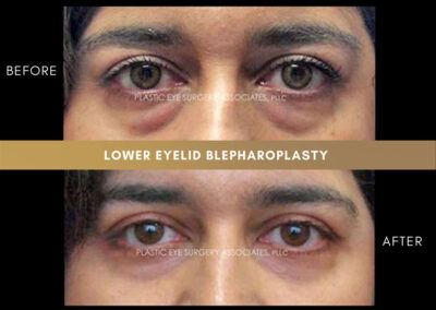 Lower Blepharoplasty Photos 3