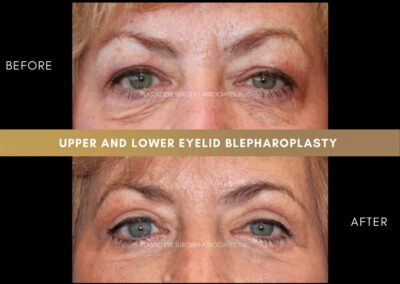 Lower Blepharoplasty Photos 4