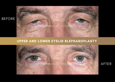 Lower Blepharoplasty Photos 5