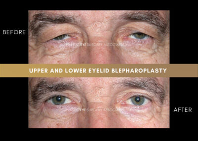 Male Blepharoplasty Photos 6