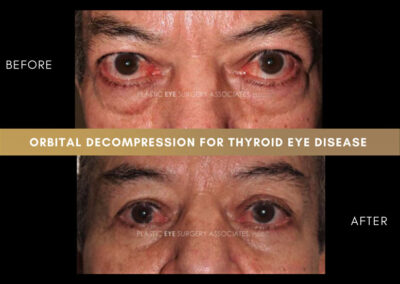 Thyroid Eye Disease Photos 30