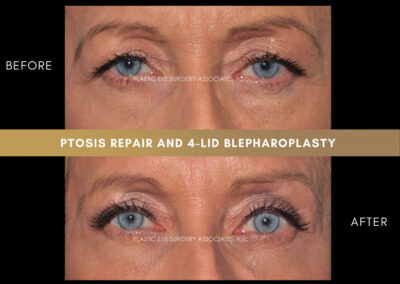 Lower Blepharoplasty Photos 7