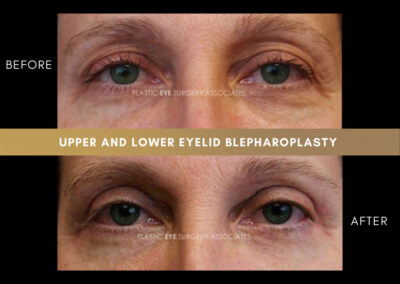 Lower Blepharoplasty Photos 8