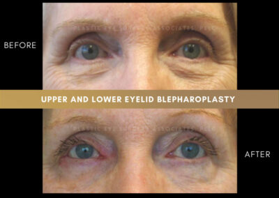Lower Blepharoplasty Photos 9
