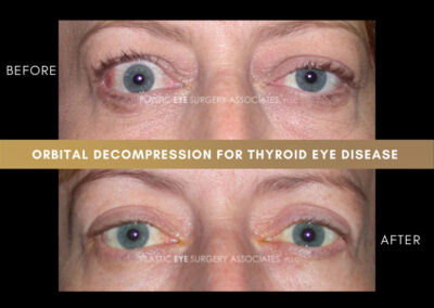 Thyroid Eye Disease Photos 32