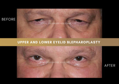 Male Blepharoplasty Photos 47