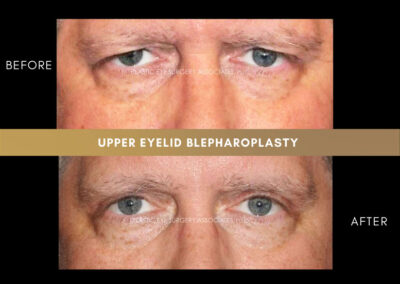 Male Blepharoplasty Photos 46