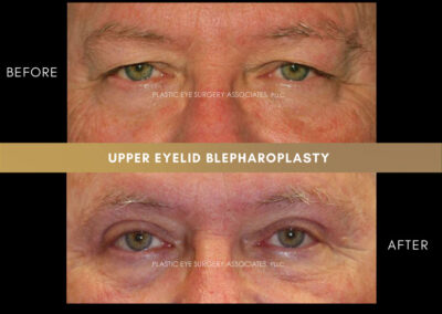Male Blepharoplasty Photos 45