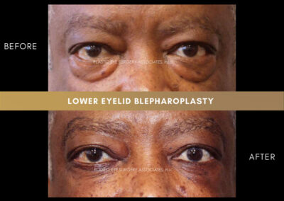 Lower Blepharoplasty Photos 11