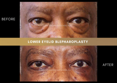 Male Blepharoplasty Photos 44