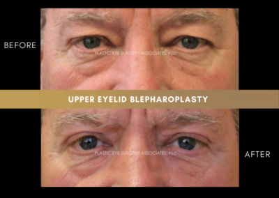 Upper Eyelid Aesthetics Photos 29