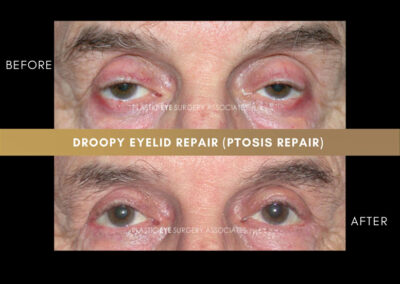 Ptosis Repair Photos 23