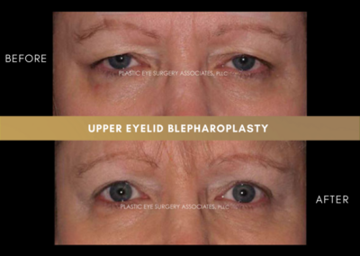 Upper Eyelid Aesthetics Photos 18