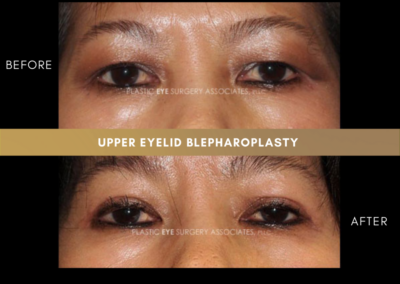 Upper Eyelid Aesthetics Photos 28
