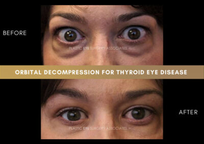 Thyroid Eye Disease Photos 7