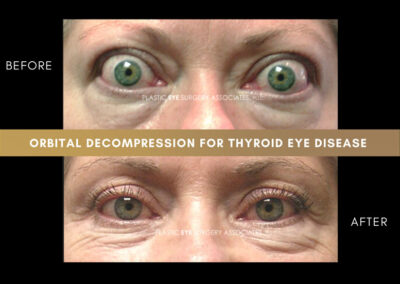 Thyroid Eye Disease Photos 38