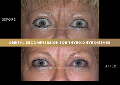 Thyroid Eye Disease Photos 42