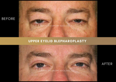 Eyelid Reshaping Photos 156