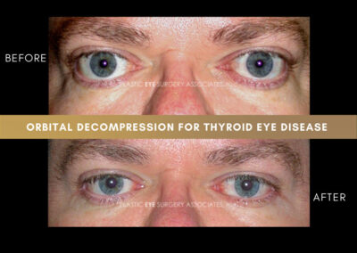 Thyroid Eye Disease Photos 43
