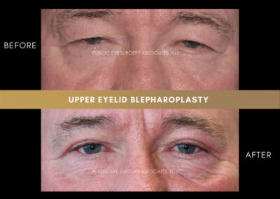 Male Blepharoplasty Photos 42