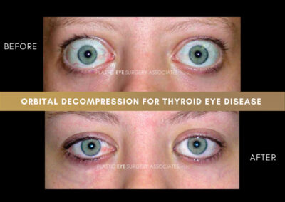 Thyroid Eye Disease Photos 44