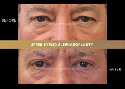 Male Blepharoplasty Photos 41