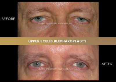 Male Blepharoplasty Photos 40