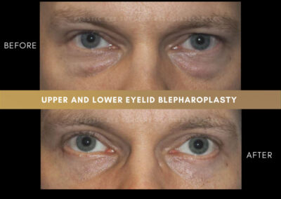 Male Blepharoplasty Photos 28