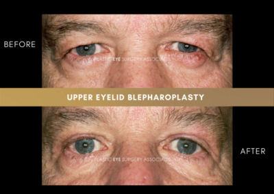 Upper Eyelid Aesthetics Photos 30