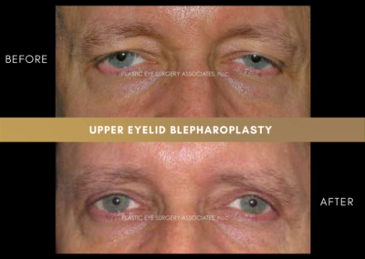 Upper Eyelid Aesthetics Photos 1