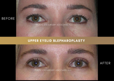 Upper Eyelid Aesthetics Photos 31