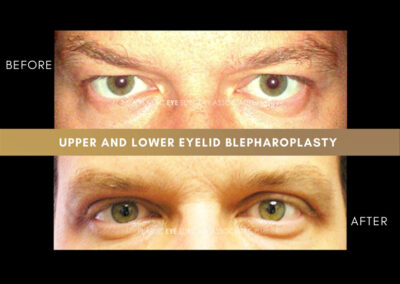Male Blepharoplasty Photos 27