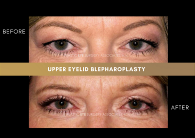 Upper Eyelid Aesthetics Photos 32