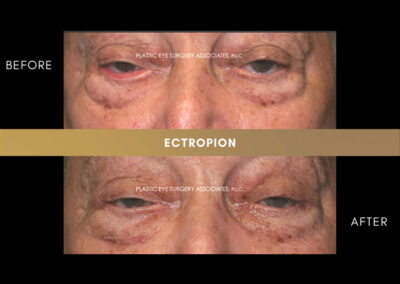 Ectropion/Entropion Photos 5